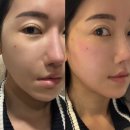 베이비멍 | 신사역 피부과 실루엣소프트 베이비리프팅 3주차 붓기, 통증, 효과 전후 차이 비교 후기