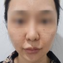 핑크힐병원 | [줄기세포 주사 솔직후기] 피부회복+피부결+컨디션 회복에 넘사벽? (vs 리쥬란 vs 유스힐 비교💕)