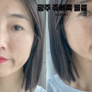 땅콩 | 광주 쥬베룩 볼륨 땅콩형 얼굴 2회차 후기