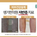 성인 자반증 증상 원인, 치료 (점상출혈, 반상출혈, 몸에 피부 붉은반점, 피멍) 이미지