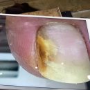“레푸스”에서 스트레스였던 엄지발톱 관리받은 후기