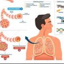 만성 폐쇄성 폐질환 COPD란? 증상 원인 예방 치료 이미지