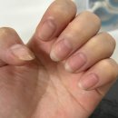 케라셀 | 손발톱영양제 추천｜문제성손발톱 관리에 도움된 케라셀네일문제성손발톱영양제 사용후기