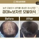 경대뉴보자르의원 | 대구모발이식 자연스러운 변화가 궁금했다면 — 경대뉴보자르의원