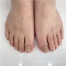 골든13(Golden13) | 광주 신창동 내성발톱 무좀발톱 복합관리 후기 골든풋 광주광산 금손네일 2호점