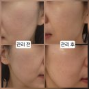 당진시 밤절로2 | [당진] 에스테틱 추천 - 읍내동여드름관리 잘하는 피부샵 아르드뽀에스테틱에서 스킨부스터 받은 후기