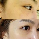 규빈왁싱&뷰티 | [동탄 피부관리, 규빈왁싱&뷰티] 퓨라셀 어븀야그 레이저로 기미, 색소침착 개선 효과 봤어요!