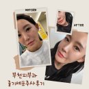 부천 중상동 유도짐 | 부천피부과 줄기세포주사후기 , 일주일 변화 찐 후기!