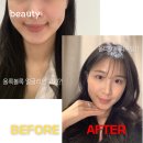 타이트짐 | 강남 피부과 처진 얼굴 고민 해결? 올타이트 리프팅 리얼 솔직 후기