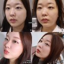 프라임킴 | 울쎄라 프라임 한달 지난 후기 통증 리프팅 효과 유지기간까지 총정리