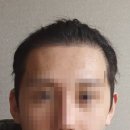 현암로89번길 | [분당 SMP, 용인 SMP] 두피라인 헤어라인커버 2회차 후기