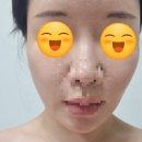 엔킴의원 | 부산 서면역 리프팅 잘하는곳 추천 (리프테라2 3000샷 시술 내돈내산 1달 솔직후기)