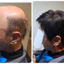 면목동-153 | 노원 중랑 맞춤전두가발 후기 면목동 고객님의 자연스러운 변신