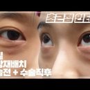 [4k] 눈밑지방재배치 + 앞광대,애교살 리프팅 여대생의 성형 고민 초근접 인터뷰 /수술 전 눈밑 고민은? 이미지