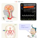 일과성 허혈 발작 transient ischemic attacks 이미지