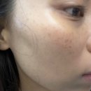주&이채현피부관리실 | 수성구 기미잡티 관리 오하이스킨 피부관리실 피코하이 미백관리 후기
