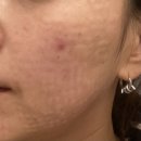 라넌클의원 | [대전/노은역피부과] 라넌클의원 _ 이중턱 고민 해결♥ 인모드, 리쥬란 시술! 내돈내산 리얼 후기