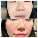 반포비앤씨피부과의원 | 반포 원베일리 피부과, 피코슈어 줌패스 리투오 내돈내산 후기(라메종피부과)