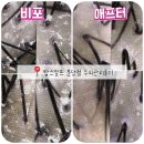 분당탑주유소 | 분당두피관리 잘하는 탑스칼프 분당점에서 탈모관리후기