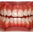 누런 치아의 치아미백을 통한 해결 (치아미백비용.치아미백가격) 이미지