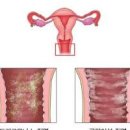 칸디다질염 냉 분비물 원인 및 예방 방법 이미지
