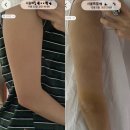 삼주 | 람스 팔뚝 지방추출 통증 무한람스 내돈내산 이주차 삼주차 솔직후기