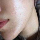 올뉴뷰티 성수점 | 성동구피부관리 올뉴뷰티에스테틱 성수 10회차 후기｜트러블·홍조 변화