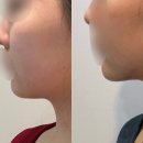 침으로한의원 | 온토르패키지 2회차 내돈내산 후기! 압구정 동안침, 스킨보톡스 효과