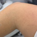 윤의원 | 구의역 피부과 맑은윤의원 팔 하완 전체 제모 후기