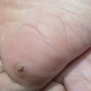 셀메드자연약국 | 셀메드 사마곤 크림으로 발바닥 사마귀 티눈 고민 해결한 후기