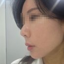 보람가정의원 | 코프팅만 세번째..코프팅 장단점정리 코성형 무서우신분들 필독