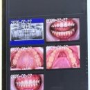 스마일치과의원 | [대전/괴정동] 디지털 스마일치과 대전 치아미백 후기ㅣ 효과, 진료후기, 신규개원