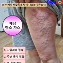 폐암 수준의 허벅지 멍~왜 그럴까? 이미지