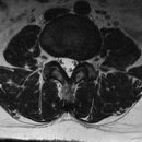 l-spine mri 이미지