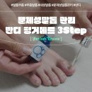 문제성발톱 무좀발톱관리 하는법 (feat. 반디 펑거메드 발톱복구 )