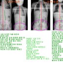 X자 다리를 교정한 후 척추측만증이 발생한 어린이의 치료 예 이미지