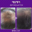 에이원헤어라인 이미지