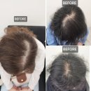 하이테디 | 천안아산SMP(두피문신) 탈모의 종류 알아보기