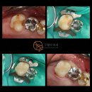 연성부부치과의원 | 모래내시장역치과 2차 충치 재발 방지를 위한 선택 이맥스 인레이 치료 구월의치과 후기