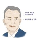 효과좋은 구안와사 관리방법 이미지