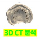 [수정구상악동]부족한 치조골을 거상술과 뼈이식으로