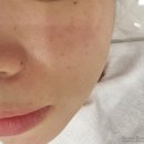 화성 남양 &#39;샤론뷰티에스테틱&#39; 세멘시트팩 파이토신 관리 후기, 문제성피부관리 여드름케어