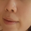 [ 광주 백운동 ] 여드름피부관리전문 아띠랑스 스킨케어