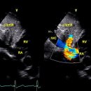 subcostal IVC 이미지