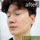 원치메디 | 오픈 이벤트 첫 방문 시 피부관리 9,000원! 대전 데자뷰메디스킨 후기!