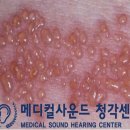 메디컬보청기 네이버블로그