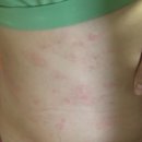 마린파크약국 | 필리핀 코론 바다 플랑크톤•해파리 쏘임 약