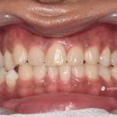 세정치과의원 | 환하게 웃는 가로수길거리처럼, 압구정치과 치아미백 케이스!