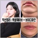 웨이브필 | 이중턱 박살내는 풀코스 관리, 신사역 피부과에 내돈내산으로 다녀왔어요!