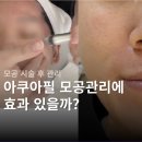 필 | 아쿠아필 내돈내산 후기 | 여름철 모공 각질 피지 효과 (+포텐자 쥬베룩 시술 후 관리)